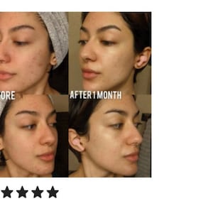 Pu&ograve; includere: Fotografie prima e dopo che mostrano il viso di una persona, illustrando i risultati di un prodotto per la cura della pelle. La foto prima mostra acne e imperfezioni, mentre la foto dopo mostra una pelle pi&ugrave; chiara. Il testo "Prima" e "Dopo 1 mese" &egrave; visibile nell'immagine.