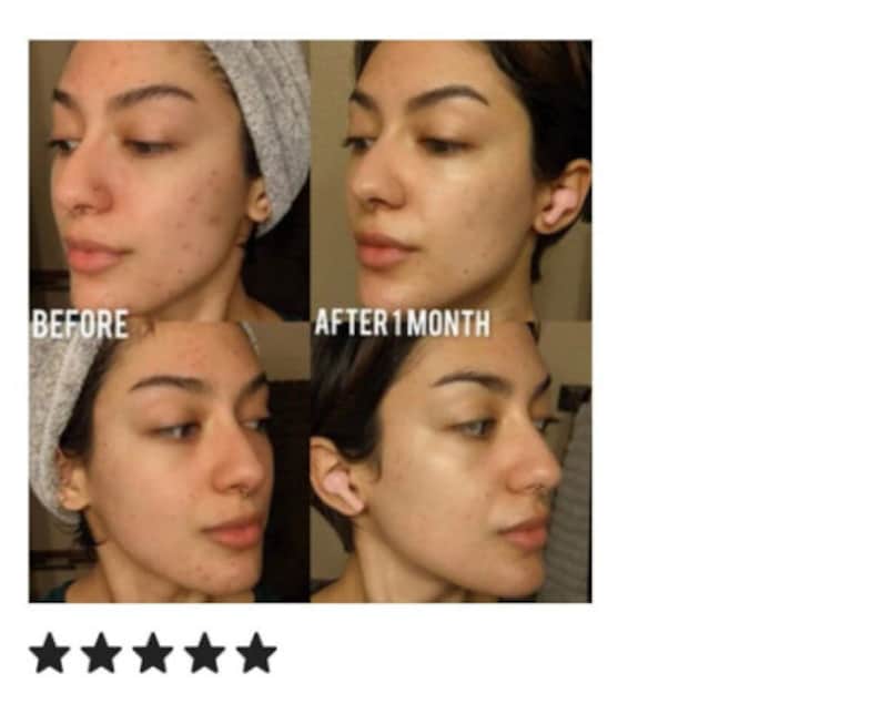 Pu&ograve; includere: Fotografie prima e dopo che mostrano il viso di una persona, illustrando i risultati di un prodotto per la cura della pelle. La foto prima mostra acne e imperfezioni, mentre la foto dopo mostra una pelle pi&ugrave; chiara. Il testo "Prima" e "Dopo 1 mese" &egrave; visibile nell'immagine.