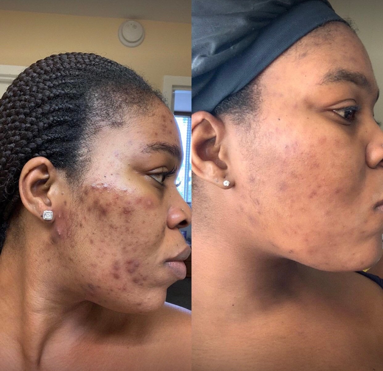 Acne bar soap acne remover dark spots remover even skin Etsy