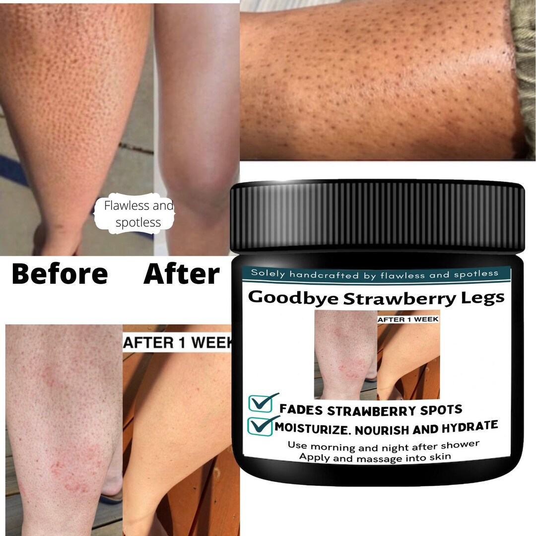 Strawberry Leg Cream Get Rid of Strawberry Legs - Etsy UK Strawberry Leg Cream Get Rid of Strawberry Legs - Etsy UK