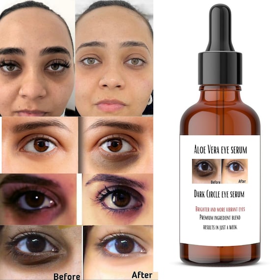 Dark Circles Remover Serum Etsy