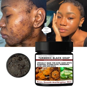 Turmeric Black Soap, Herbal Soap, Plant Based Soap, Acne Soap, Dark Spot Remover, Blemish Soap, Even Skin Tone, Smooth Skin, Glowing Skin