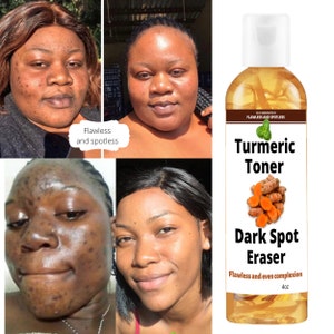 Turmeric toner, dark spot corrector, turmeric, fades blemishes, dark spots remover, acne remover