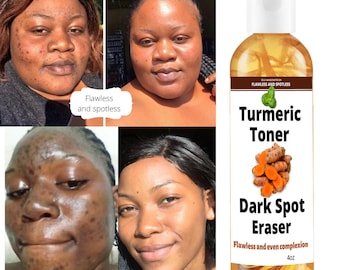 Turmeric toner, dark spot corrector, turmeric, fades blemishes, dark spots remover, acne remover