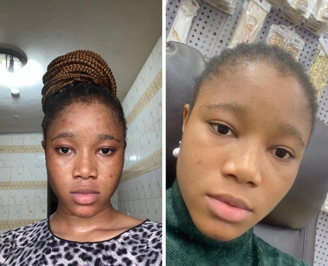 Turmeric Serum Dark Spot Remover Glowing Flawless Skin Dark Etsy UK