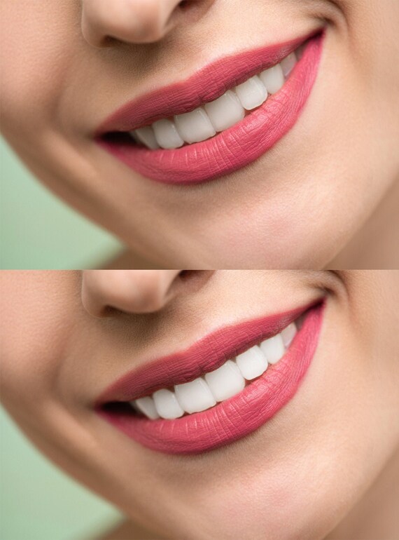 Teeth Whitening Action Whiten Teeth Teeth Etsy