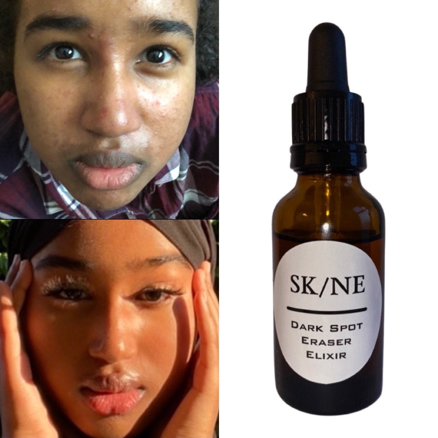 Dark Spot Eraser Elixir Clears Hyperpigmentation & Acne Etsy