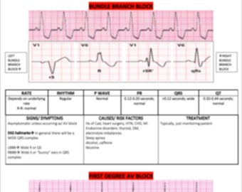 BBB and First Degree AV Block
