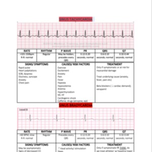 Sinus Dysrhythmia&#39;s, EKG Interpretation