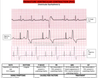 PVC's, EKG interpretation