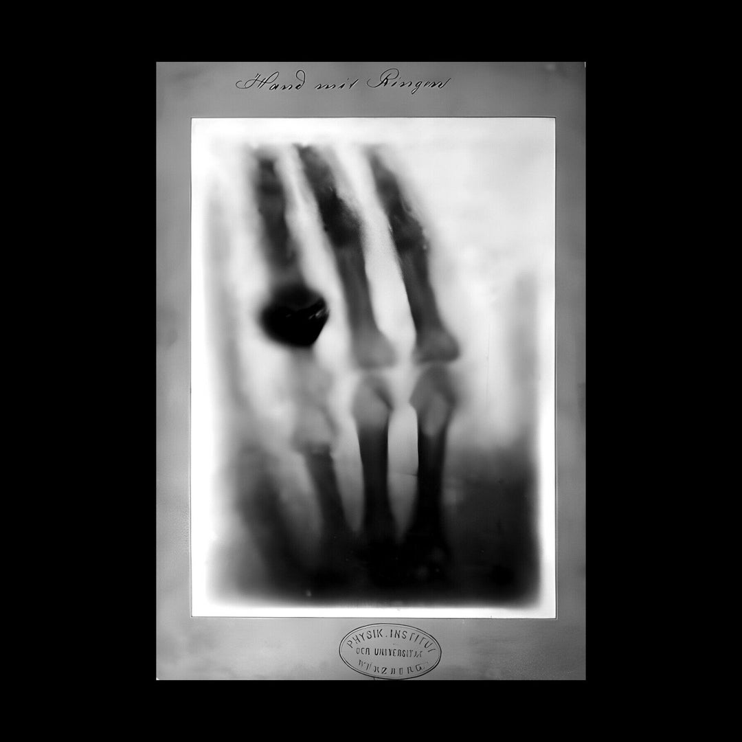 Radiograph of Hand by W.K. Roentgen Xray Xray Ring Photo Poster Art Print 18 X 24 In Etsy