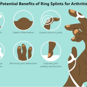May include: Illustration showing potential benefits of using ring splints for arthritis. The illustration shows a hand wearing ring splints and six icons depicting the benefits: decreasing pain, lowering inflammation, lessening stress on joints, promoting proper joint alignment, minimizing joint deformities, and improving joint stability and function.