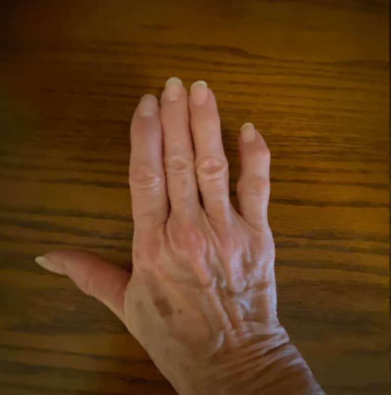 Arthritis Finger Splint for Bending Sideways Lateral Deviation Etsy UK