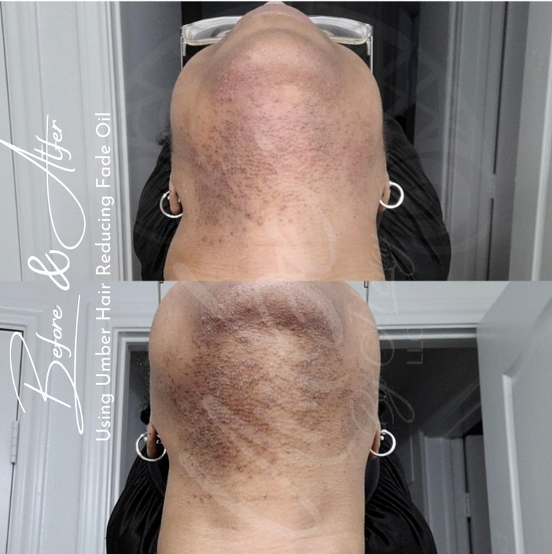 Hair Reducing Fade Oil Hair Inhibitor Hair Removal PCOS / Etsy