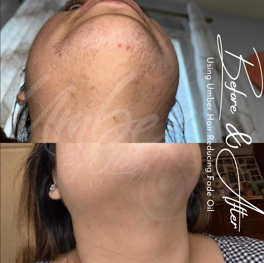 Hair Reducing Fade Oil Hair Inhibitor Hair Removal PCOS Etsy