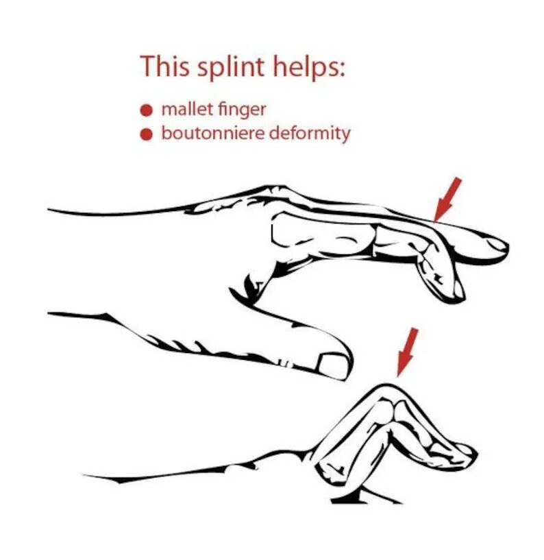 Arthritis Finger Splint for Bending Sideways Lateral Deviation Sterling