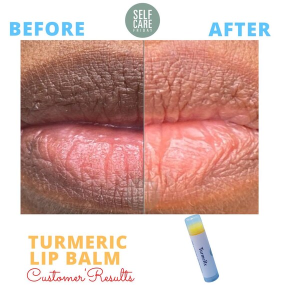 Smoker Lips Turmeric Lip Balm Chapped Lips Healing Balm Etsy UK