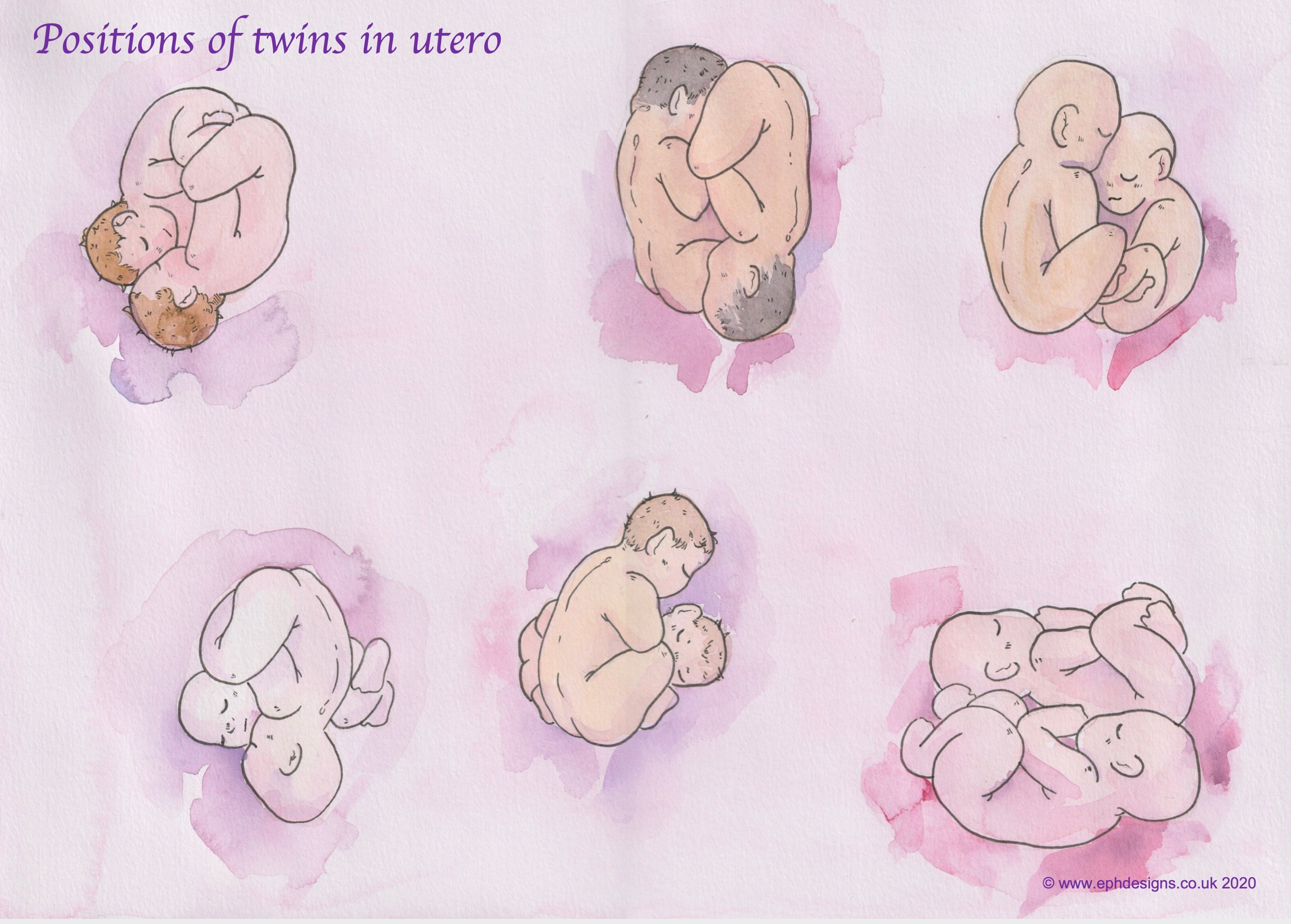 Positions of Twins in Utero - Hand Painted A3 Poster - Etsy