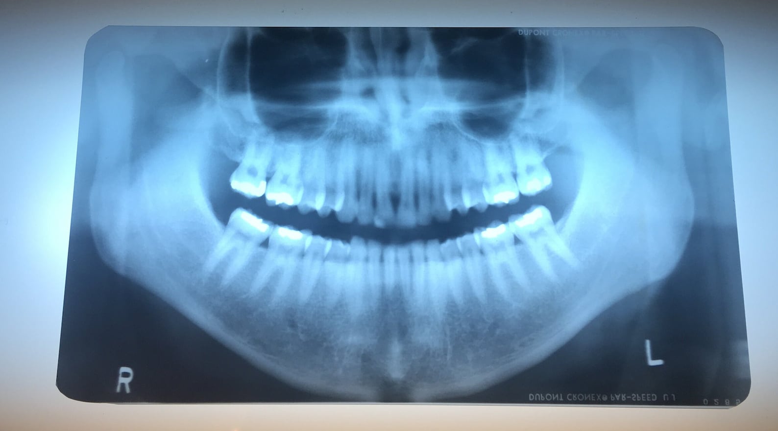 Vintage Dental Xray Films Panoramic Etsy