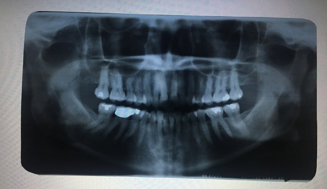 Vintage Dental Xray Films Panoramic Etsy