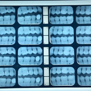 Vintage Dental X-ray Sets in Black (or Green) Plastic Holder