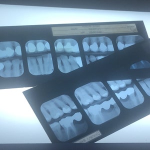 Vintage Dental X-ray Sets in Black (or Green) Plastic Holder - Etsy