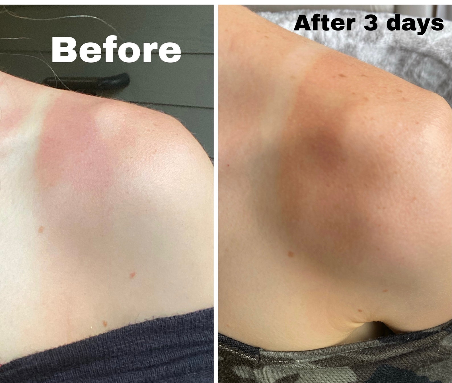 Cooling Burn Spray nontoxic Etsy