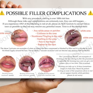 A4 POSTER Estetica Dermal & Lip Filler Complicazioni Schede per i clienti - DOWNLOAD SOLO