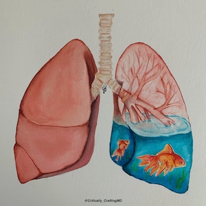 Pleural Effusion