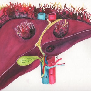 Liver on Fire