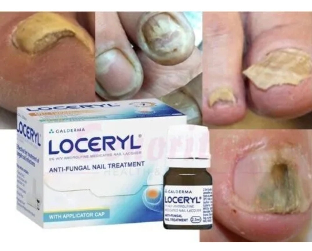 LOCERYL Nail Polish Anti-Fungus Nail Polish 3 ml : Amazon.de: Beauty