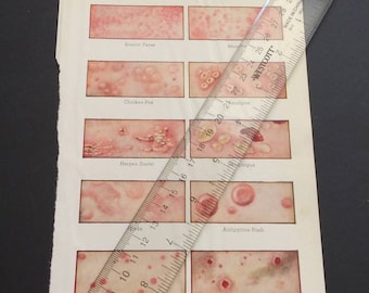 Hautausschlag Maaseln Nesselsucht Plattendruck Infektion Medizinisches Buch Bibliothek Vintage Antikes Handbuch Nachschlagewerk Seltsames Geschenk Horror Decor