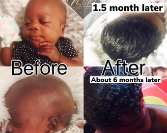 MY CHILD HAS HAIR LOSS IN PATCHES CAN IT BE TREATED  Dr Batras