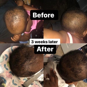 Puede incluir: Fotos de antes y despu&eacute;s de la cabeza de un beb&eacute; que muestran el crecimiento del cabello. La foto superior muestra la cabeza del beb&eacute; con muy poco cabello. La foto inferior muestra la cabeza del beb&eacute; con una cabeza llena de cabello. El texto "Antes" est&aacute; escrito sobre la foto superior y el texto "Despu&eacute;s" est&aacute; escrito sobre la foto inferior. El texto "3 semanas despu&eacute;s" est&aacute; escrito entre las dos fotos.