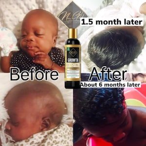 May include: Before and after photos of a baby's hair growth. The baby's hair is very short in the before photo. In the after photo, the baby's hair is much longer and appears to be curly. The text "1.5 month later" is above the after photo. The text "About 6 months later" is below the after photo. A bottle of "Growth Boosting Conditioner" is visible in the center of the image.