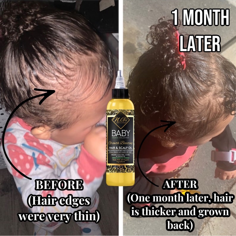 Puede incluir: Fotos de antes y despu&eacute;s del cabello de un ni&ntilde;o. La foto de antes muestra bordes de cabello finos. La foto de despu&eacute;s muestra bordes de cabello m&aacute;s gruesos despu&eacute;s de usar un aceite para cabello y cuero cabelludo etiquetado como "Baby Growth Boosting Hair & Scalp Oil". El texto "1 Month Later" es visible en la imagen.