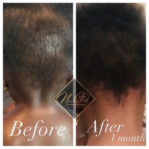 Puede incluir: Fotos de antes y despu&eacute;s que muestran los resultados de un tratamiento para el crecimiento del cabello. La foto de antes muestra el cuero cabelludo de una persona con adelgazamiento visible del cabello. La foto de despu&eacute;s muestra el cuero cabelludo de la misma persona con cabello m&aacute;s grueso y abundante despu&eacute;s de un mes de tratamiento. El texto "Noir Gold" es visible en la imagen.