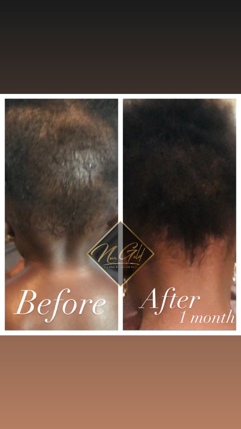 Puede incluir: Fotos de antes y despu&eacute;s que muestran los resultados de un tratamiento para el crecimiento del cabello. La foto de antes muestra el cuero cabelludo de una persona con adelgazamiento visible del cabello. La foto de despu&eacute;s muestra el cuero cabelludo de la misma persona con cabello m&aacute;s grueso y abundante despu&eacute;s de un mes de tratamiento. El texto "Noir Gold" es visible en la imagen.