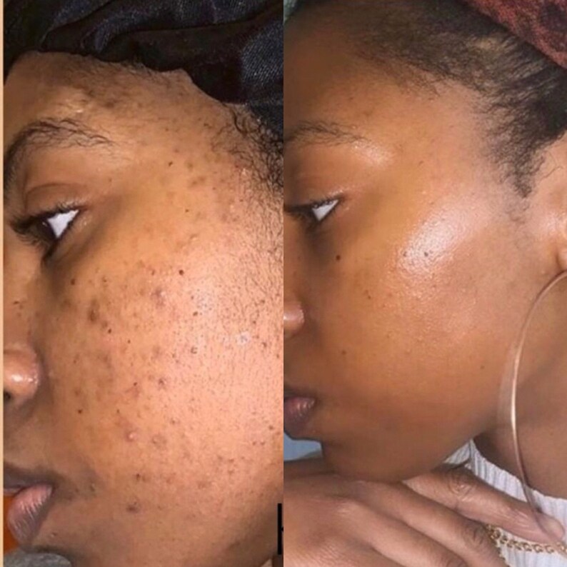 Turmeric Aloe Vera and Honey Scrub Dark Spots Remover Smooth Etsy