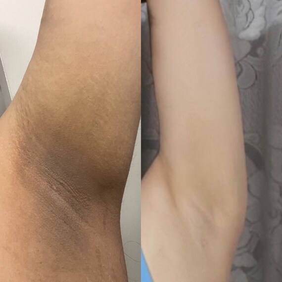 Dark Underarms Cream Underarm Brightening Cream Fast Action - Etsy