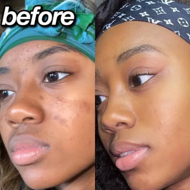 Turmeric Kojic Bar Soap Dark Spots Remover Acne Remover Etsy