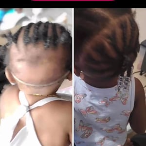 May include: Before and after photos of a young girl's hair. The before photo shows the girl's hair with a bald spot on the top of her head. The after photo shows the girl's hair with a full head of hair.