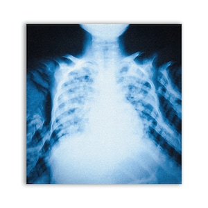 Puede incluir: Una imagen de rayos X en blanco y negro del pecho de una persona, que muestra las costillas, los pulmones y el corazón.