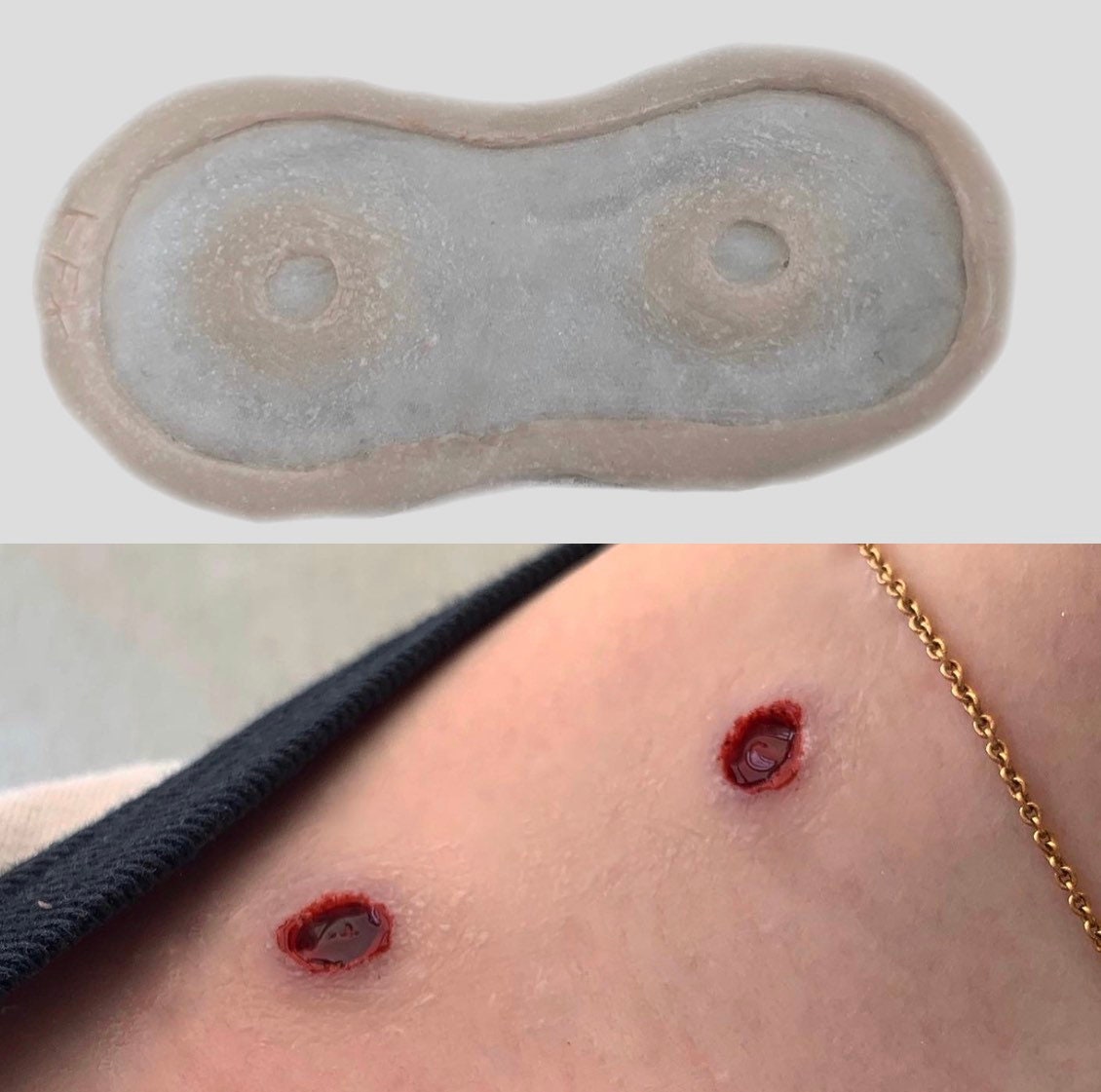 Real Vampire Bite Marks