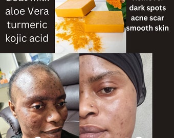 Savon pour le visage au curcuma et à l'aloe vera, très efficace, élimine les taches brunes, les cicatrices d'acné, mousse bien, 100 % naturel !