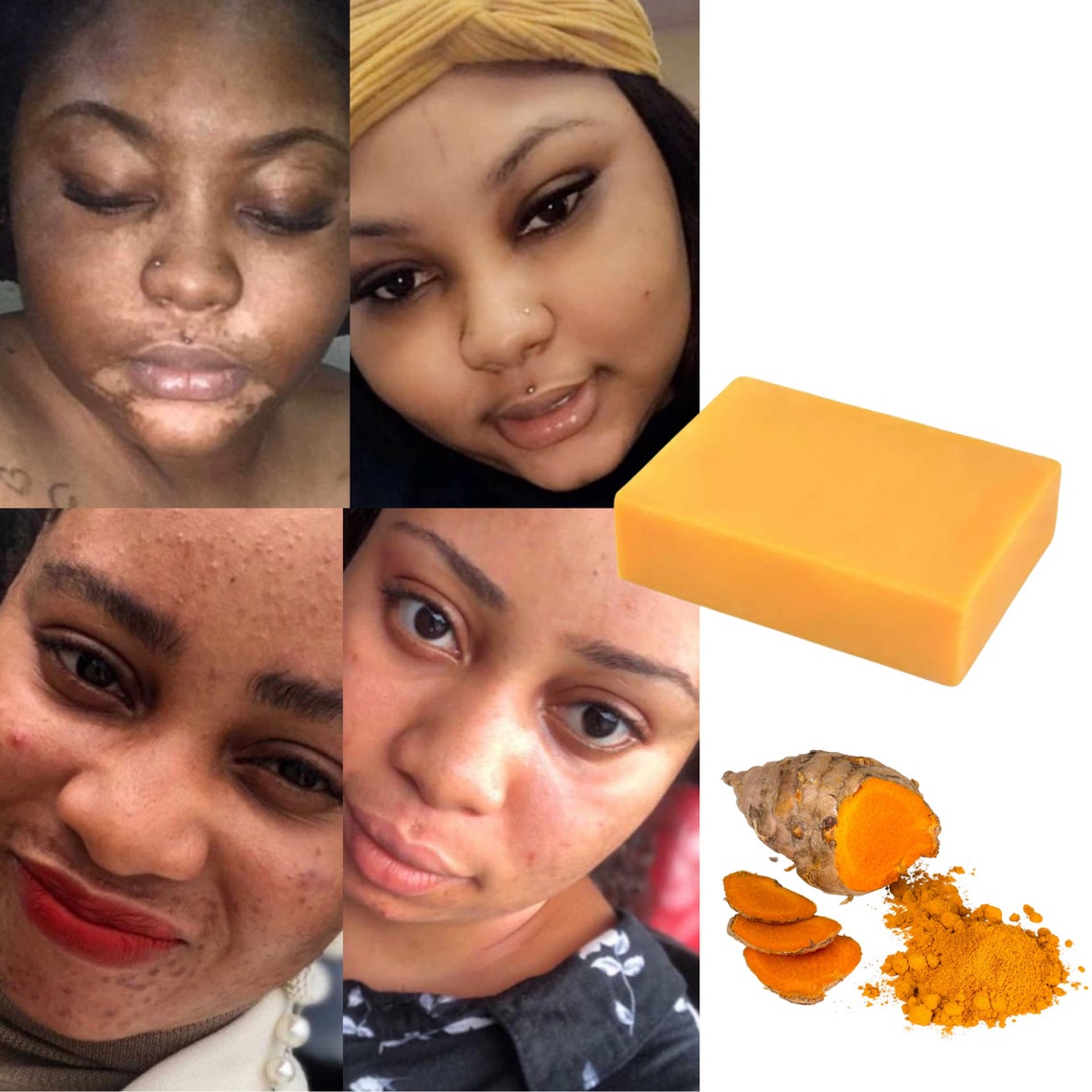 Turmeric kojic bar soap dark spots remover acne remover Etsy
