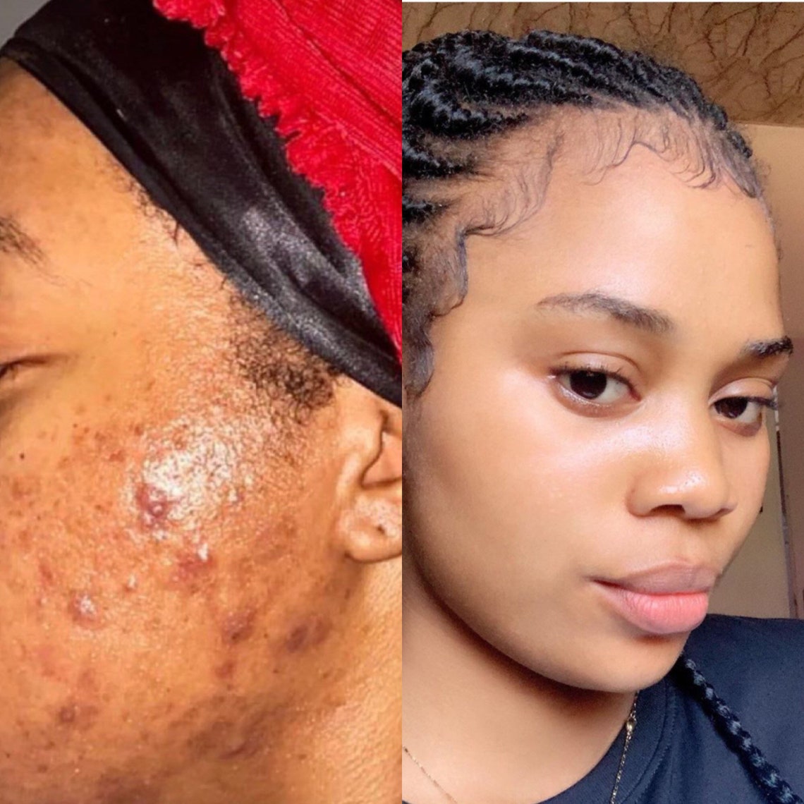 Kojic Turmeric Face Cream Dark Spots Remover Blemish Etsy