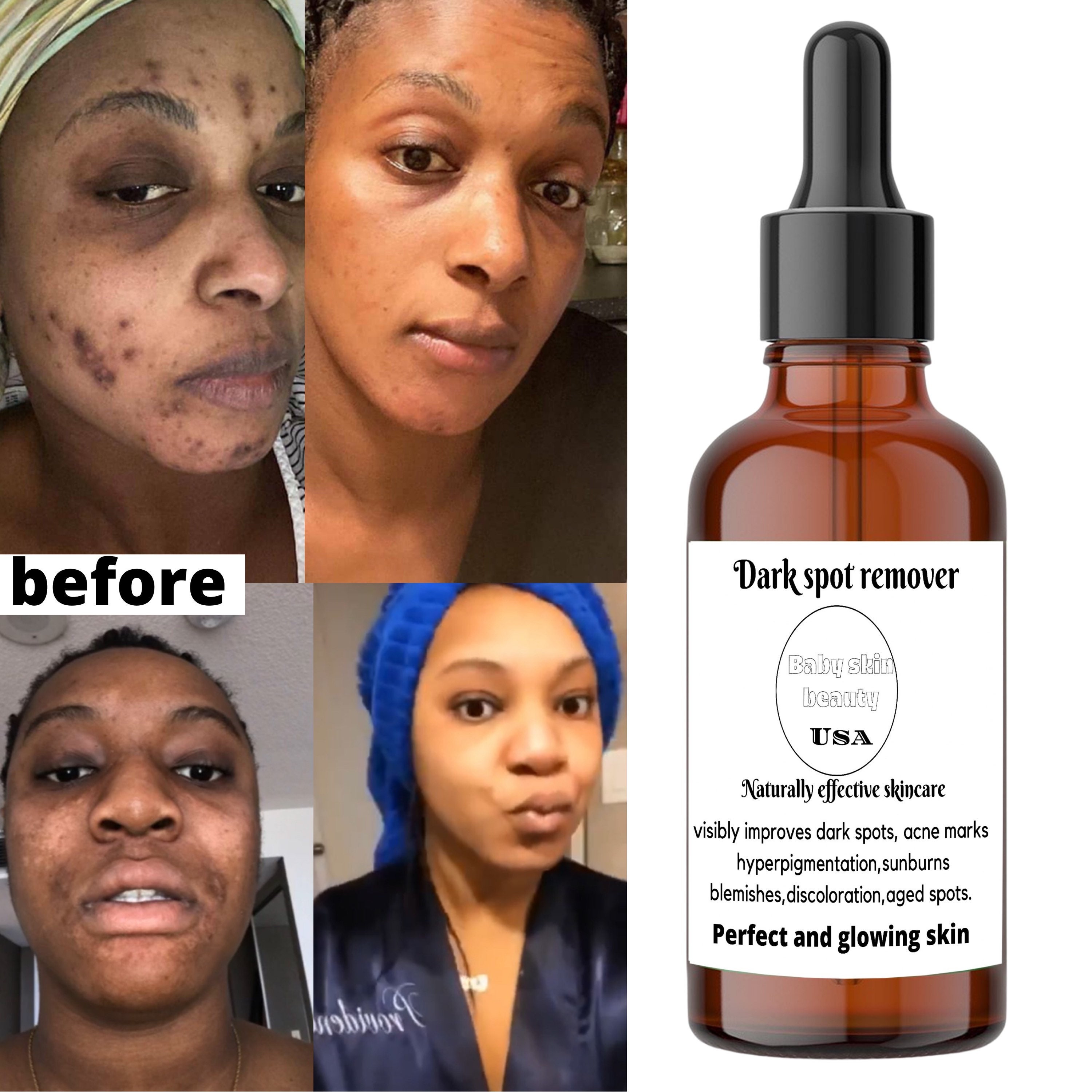 Dark Spots Remover Face Serum Etsy