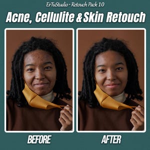 May include: Image comparing skin before and after retouching. The text at the top reads "ErTuStudio • Retouch Pack 10 Acne, Cellulite & Skin Retouch." The "before" image shows skin with acne, while the "after" image shows clear skin. A person is holding a yellow face mask.