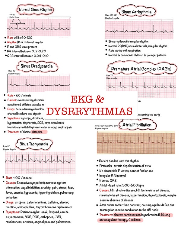 13 Cardiac Rhythm and Dysrhythmias Cheat Sheet Any Nurse Must Know for ...
